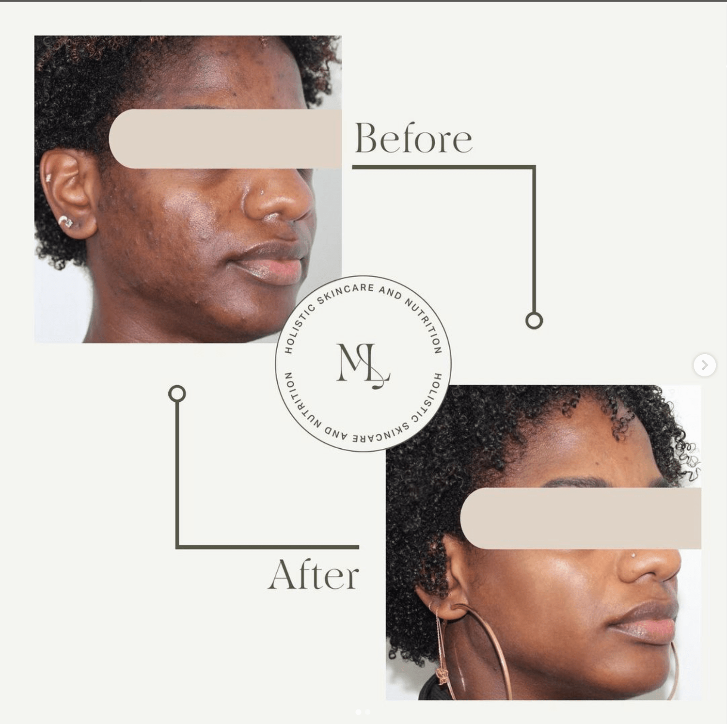 Non Inflamed Acne Routine - ML Aesthetic Clinic - ML Aesthetic Clinic