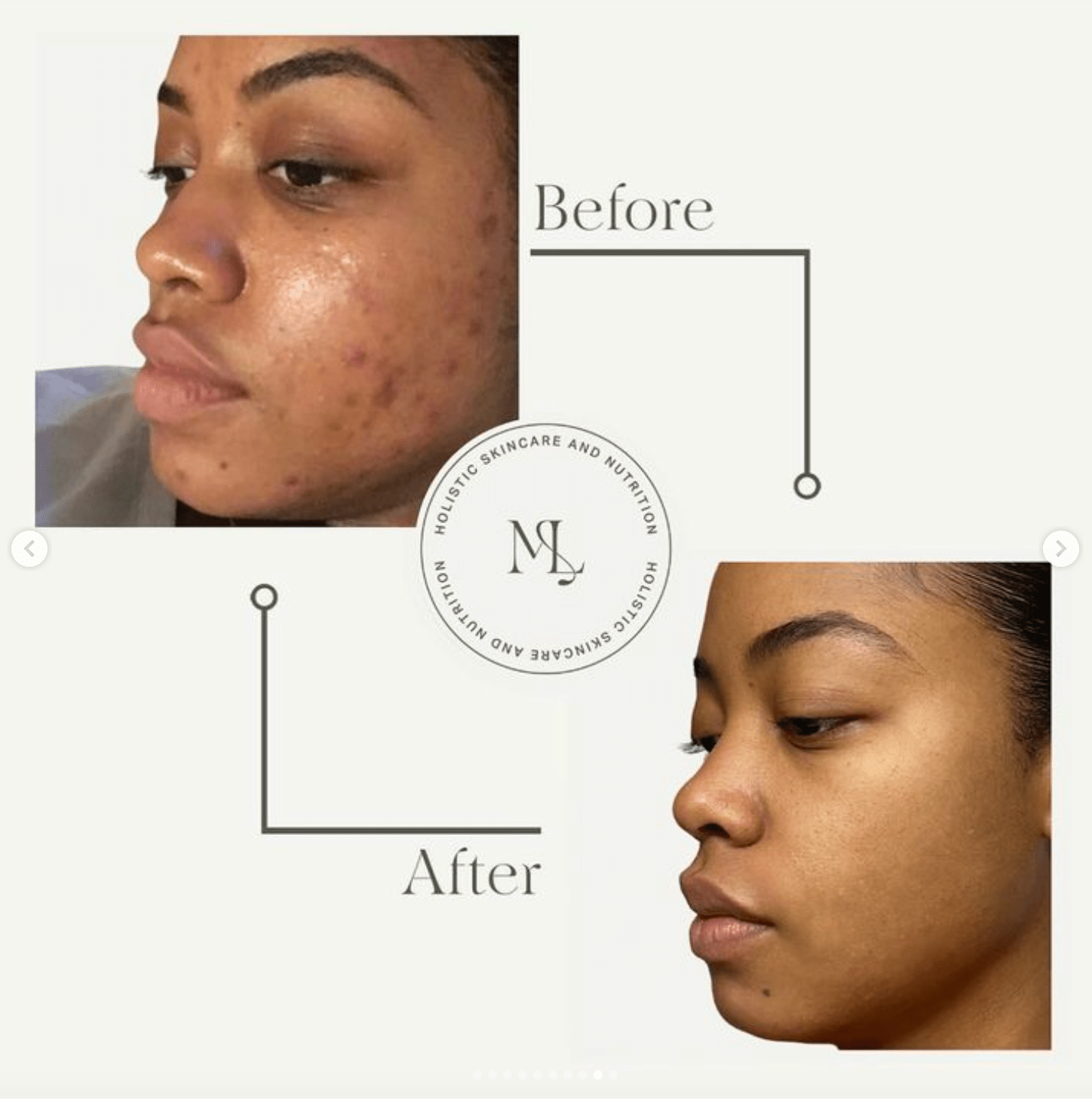 Non Inflamed Acne Routine - ML Aesthetic Clinic - ML Aesthetic Clinic