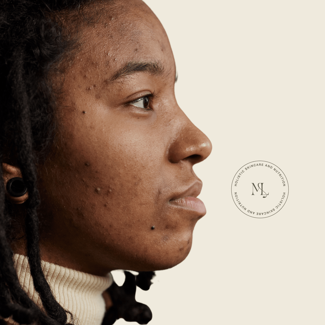How to treat PIH on Dark skin ? - ML Aesthetic Clinic