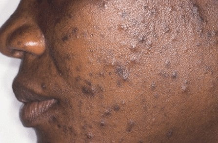 Understanding the Science Behind Dark Spot Treatments