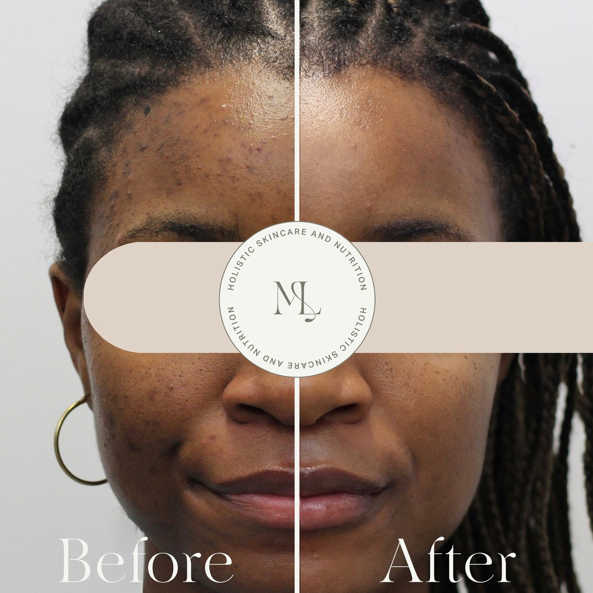 Dark Spot Bootcamp - 3-Month Intensive Hyperpigmentation Treatment in Montreal